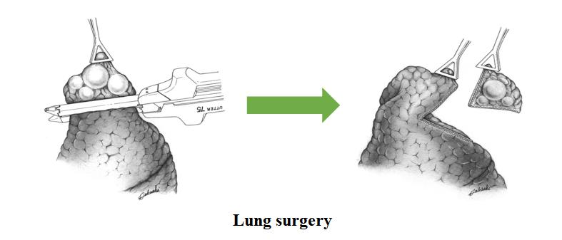 lung surgery
