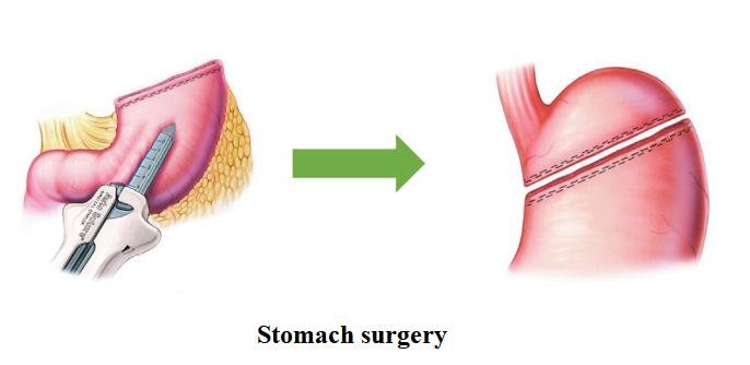 stomach surgery